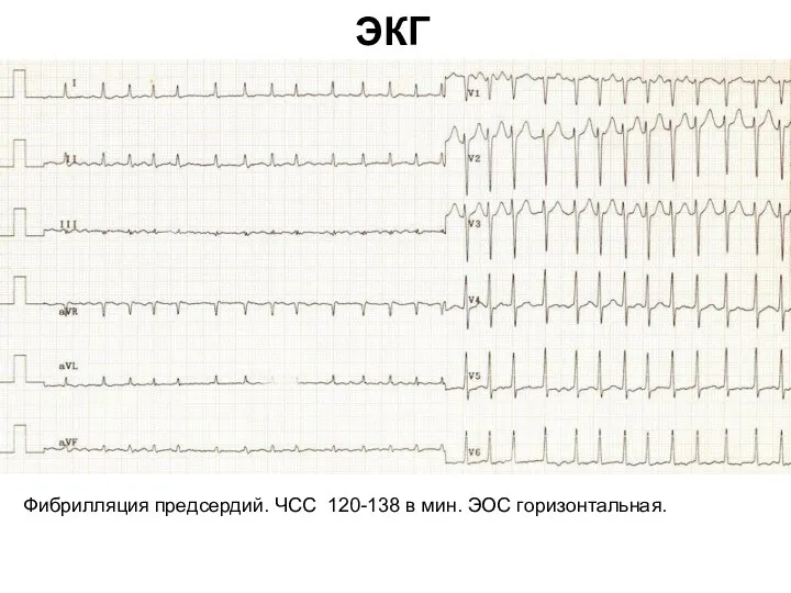 ЭКГ Фибрилляция предсердий. ЧСС 120-138 в мин. ЭОС горизонтальная.