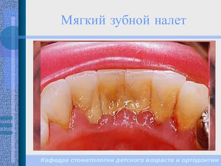 Мягкий зубной налет – белое или желтое мягкое и липкое