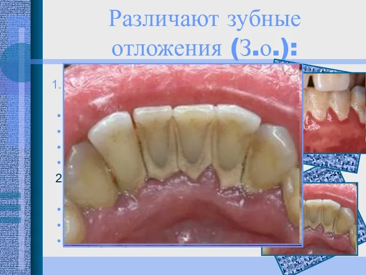 Различают зубные отложения (З.о.): Неминерализованные зубные отложения а) пелликула б)