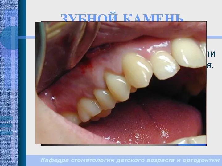 ЗУБНОЙ КАМЕНЬ Кафедра стоматологии детского возраста и ортодонтии — минерализованные аморфные или кристаллические зубные отложения.