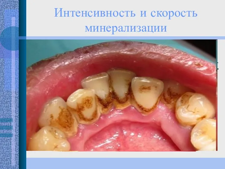 Интенсивность и скорость минерализации исключительно индивидуальна и зависит от различных