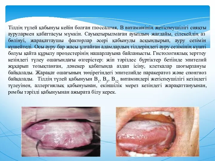 Тiлдiң түлей қабынуы кейiн болған глоссалгия, В витаминiнiң жетiспеушiлiгi сияқты