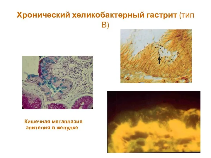 Хронический хеликобактерный гастрит (тип В) Кишечная метаплазия эпителия в желудке