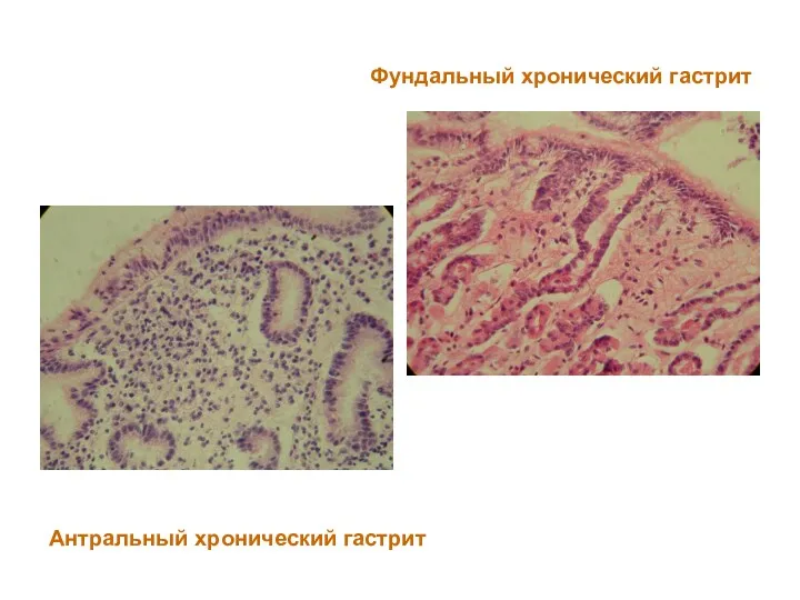 Фундальный хронический гастрит Антральный хронический гастрит