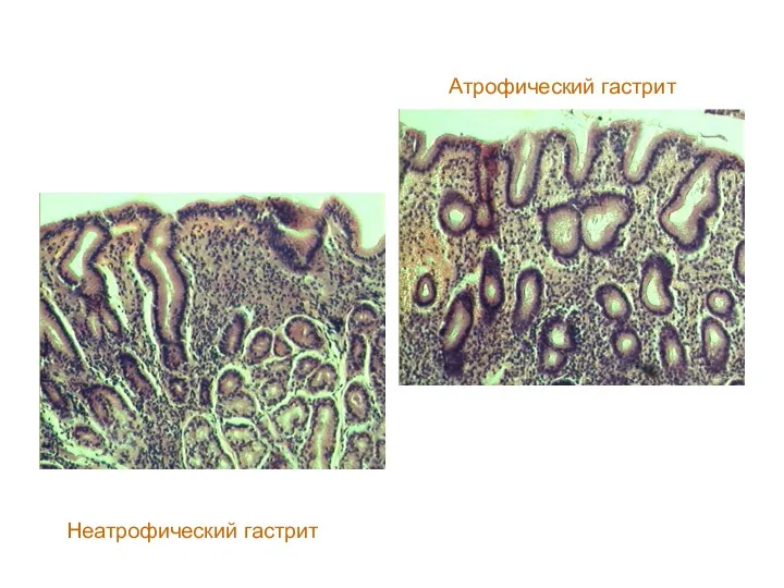 Атрофический гастрит Неатрофический гастрит