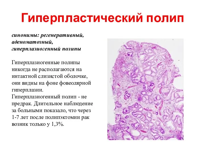 Гиперпластический полип синонимы: регенеративный, аденоматозный, гиперплазиогенный полипы Гиперплазиогенные полипы никогда