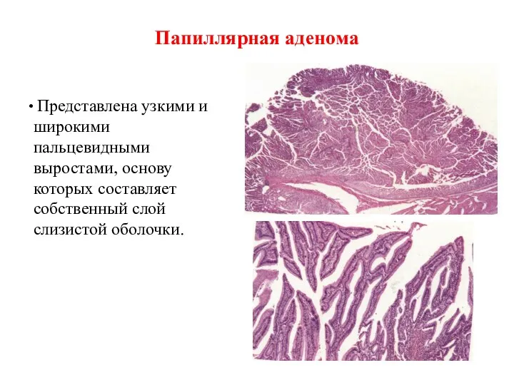 Папиллярная аденома Представлена узкими и широкими пальцевидными выростами, основу которых составляет собственный слой слизистой оболочки.