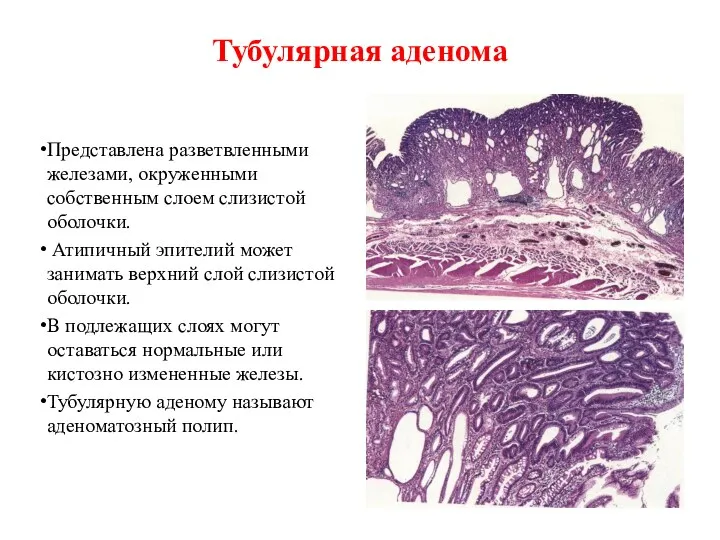 Тубулярная аденома Представлена разветвленными железами, окруженными собственным слоем слизистой оболочки.