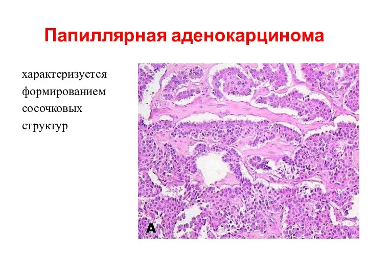 Папиллярная аденокарцинома характеризуется формированием сосочковых структур характеризуется формированием сосочковых структур