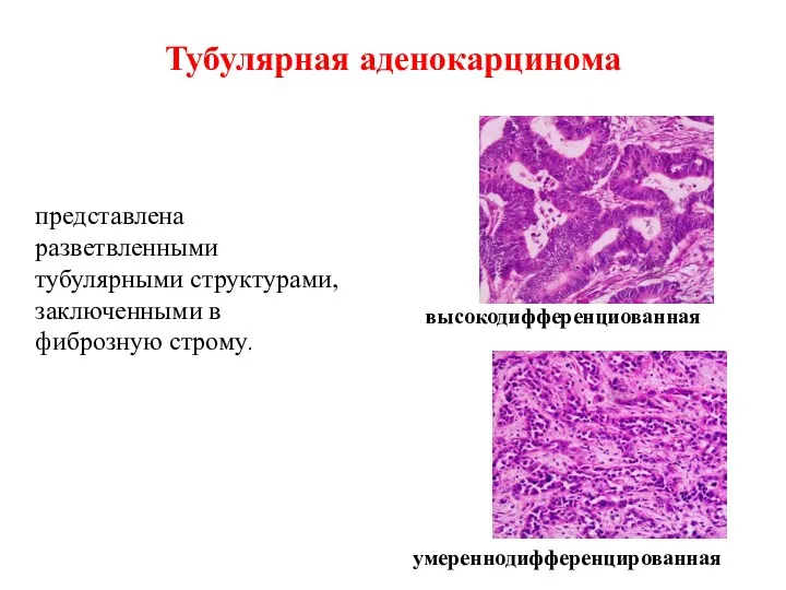 Тубулярная аденокарцинома высокодифференциованная умереннодифференцированная представлена разветвленными тубулярными структурами, заключенными в фиброзную строму.