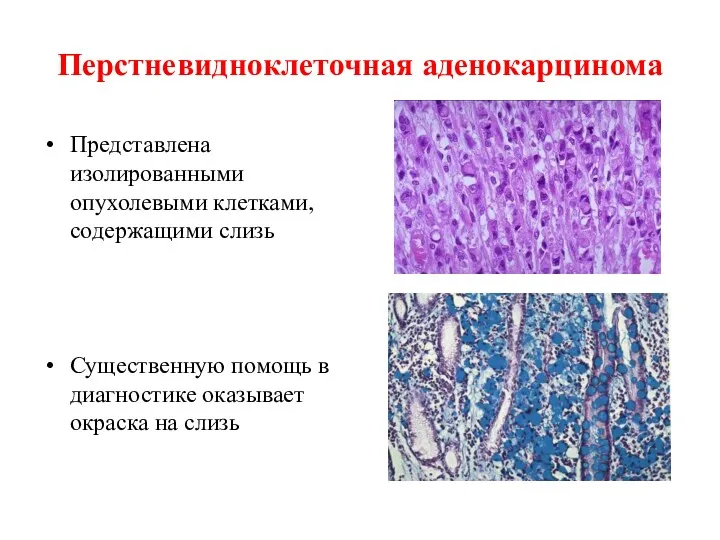 Перстневидноклеточная аденокарцинома Представлена изолированными опухолевыми клетками, содержащими слизь Существенную помощь в диагностике оказывает окраска на слизь