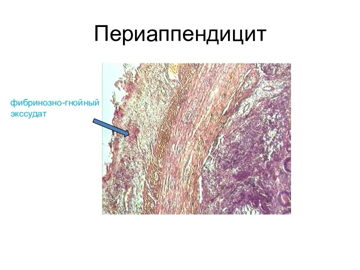 Периаппендицит фибринозно-гнойный экссудат