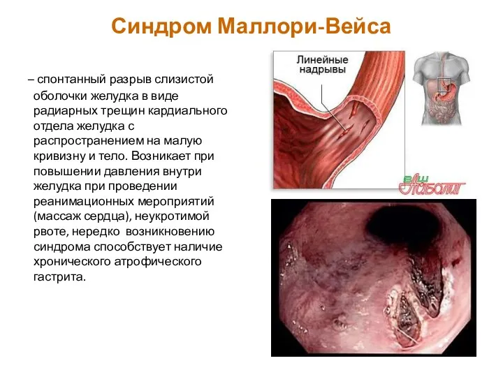 Синдром Маллори-Вейса – спонтанный разрыв слизистой оболочки желудка в виде