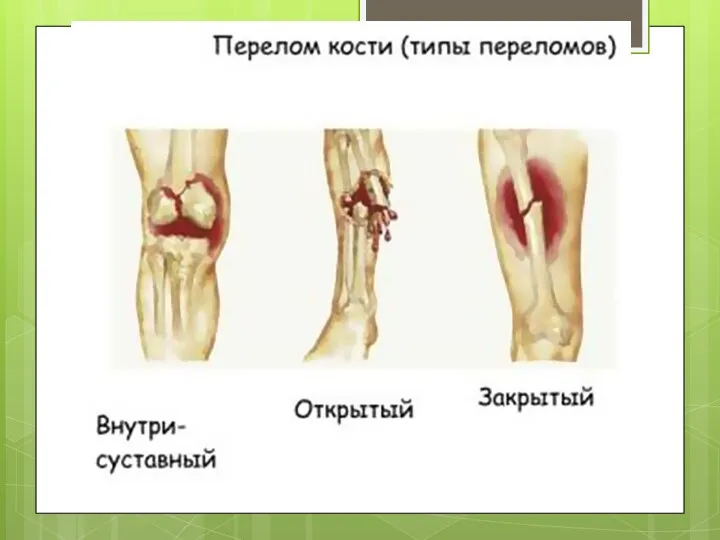 Классификация переломов В зависимости от того, сообщается ли костная рана