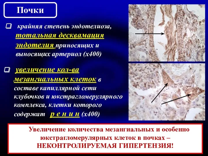 крайняя степень эндотелиоза, тотальная десквамация эндотелия приносящих и выносящих артериол