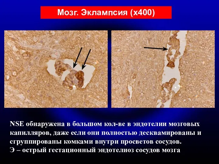 NSE обнаружена в большом кол-ве в эндотелии мозговых капилляров, даже