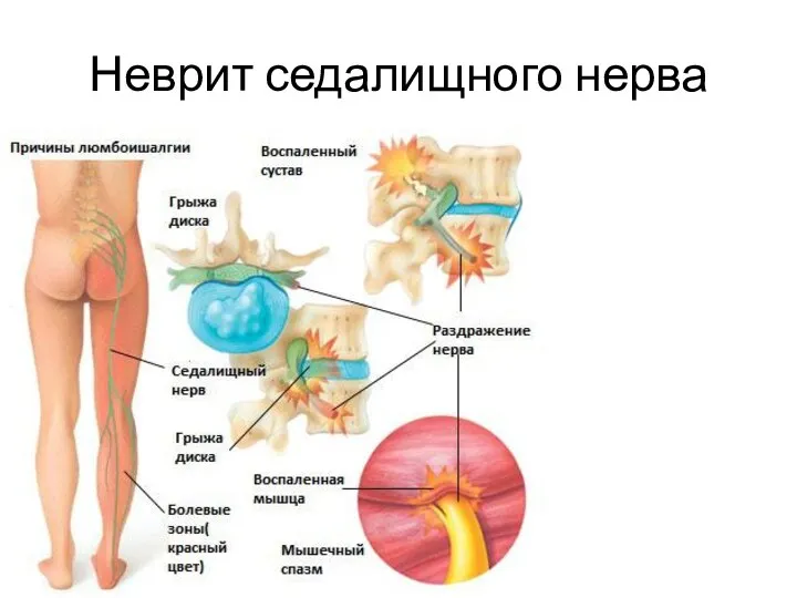 Неврит седалищного нерва