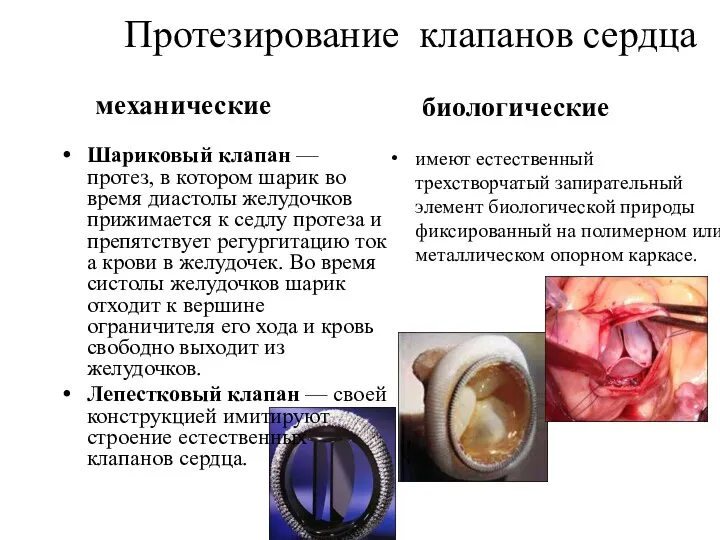 Протезирование клапанов сердца механические Шариковый клапан — протез, в котором шарик во время