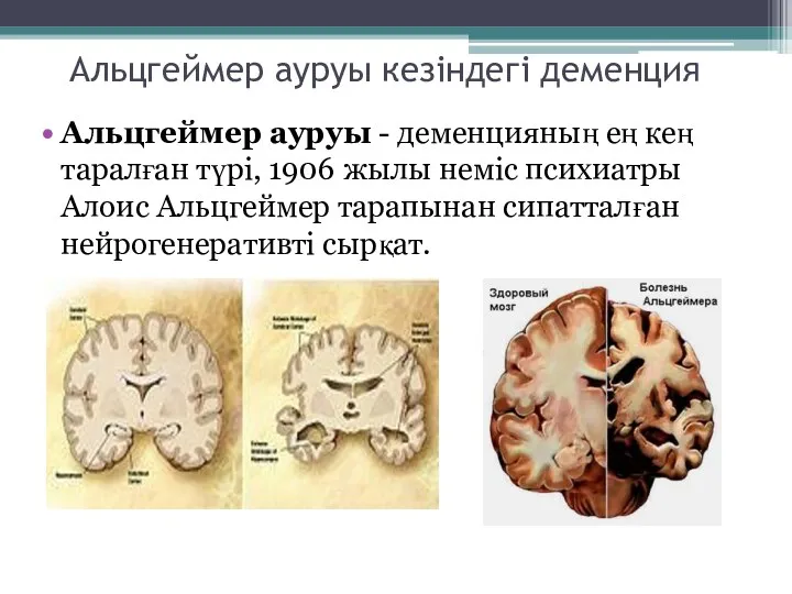 Альцгеймер ауруы кезіндегі деменция Альцгеймер ауруы - деменцияның ең кең