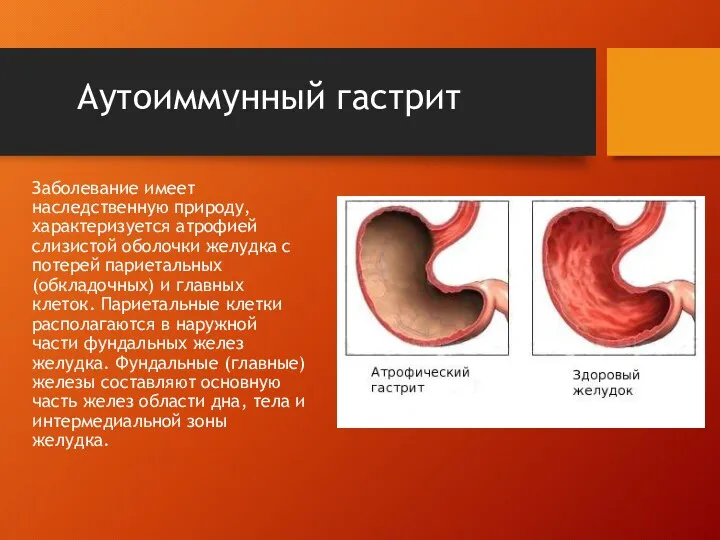 Аутоиммунный гастрит Заболевание имеет наследственную природу, характеризуется атрофией слизистой оболочки желудка с потерей