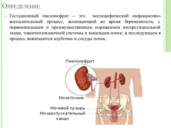 Определение Гестационный пиелонефрит – это неспецифический инфекционно-воспалительный процесс, возникающий во