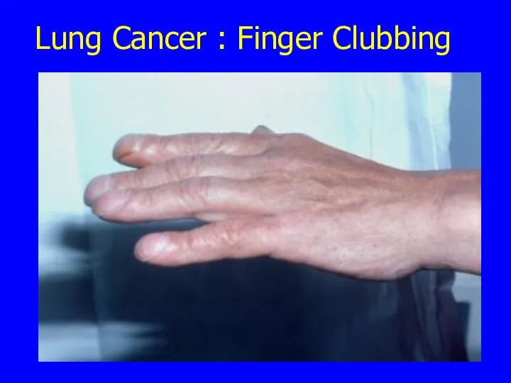Lung Cancer : Finger Clubbing