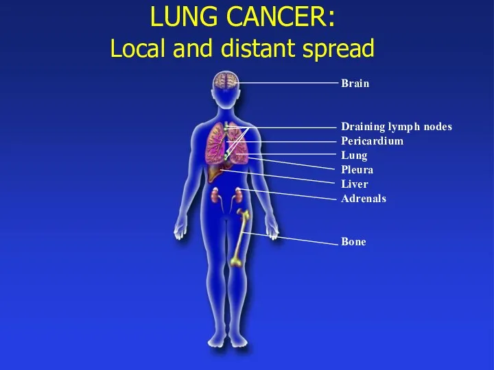 LUNG CANCER: Local and distant spread Brain Draining lymph nodes Pericardium Lung Pleura Liver Adrenals Bone