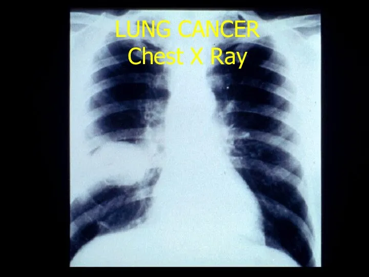 LUNG CANCER Chest X Ray