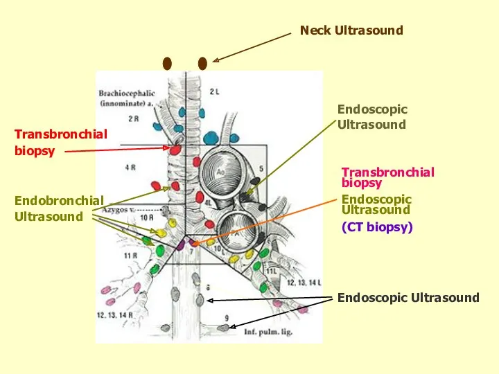 Transbronchial biopsy Endoscopic Ultrasound (CT biopsy) Endoscopic Ultrasound Endoscopic Ultrasound Neck Ultrasound Endobronchial Ultrasound Transbronchial biopsy