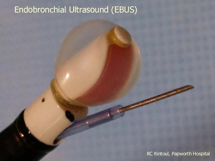 RC Rintoul, Papworth Hospital Endobronchial Ultrasound (EBUS)