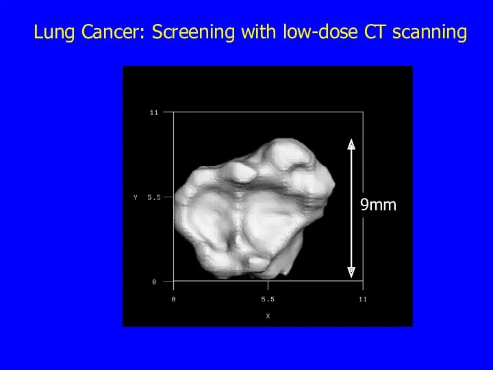Lung Cancer: Screening with low-dose CT scanning 9mm