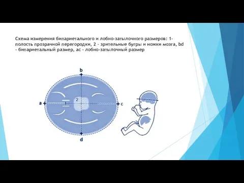 Схема измерения бипариетального и лобно-затылочного размеров: 1-полость прозрачной перегородки, 2