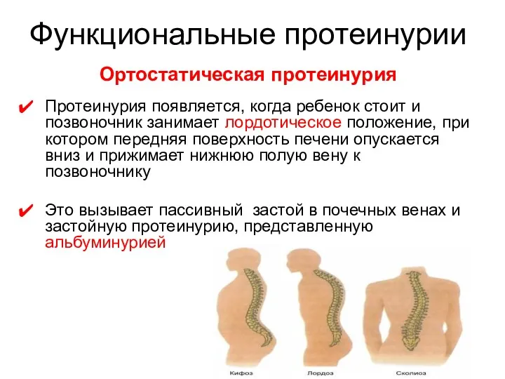 Протеинурия появляется, когда ребенок стоит и позвоночник занимает лордотическое положение,