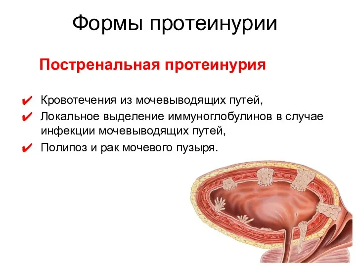 Постренальная протеинурия Кровотечения из мочевыводящих путей, Локальное выделение иммуноглобулинов в