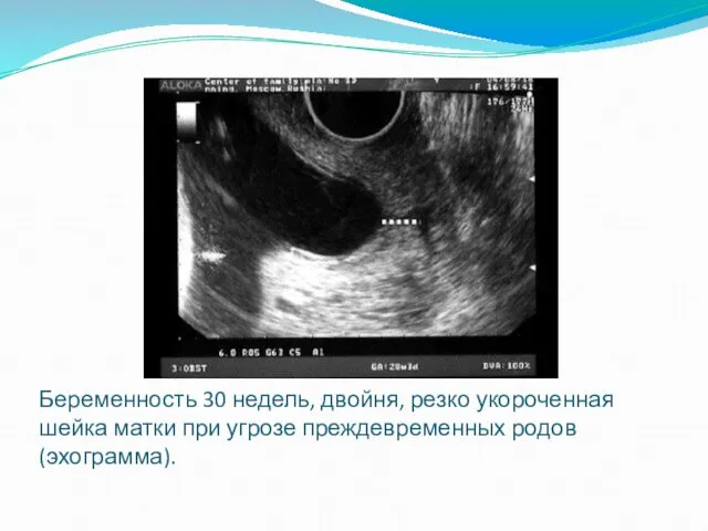 Беременность 30 недель, двойня, резко укороченная шейка матки при угрозе преждевременных родов (эхограмма).