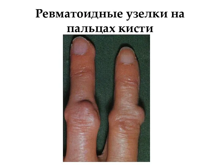 Ревматоидные узелки на пальцах кисти