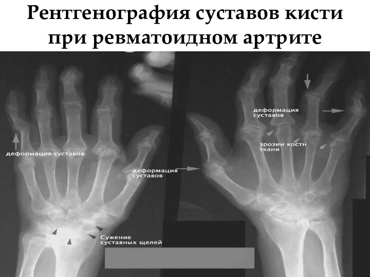Рентгенография суставов кисти при ревматоидном артрите