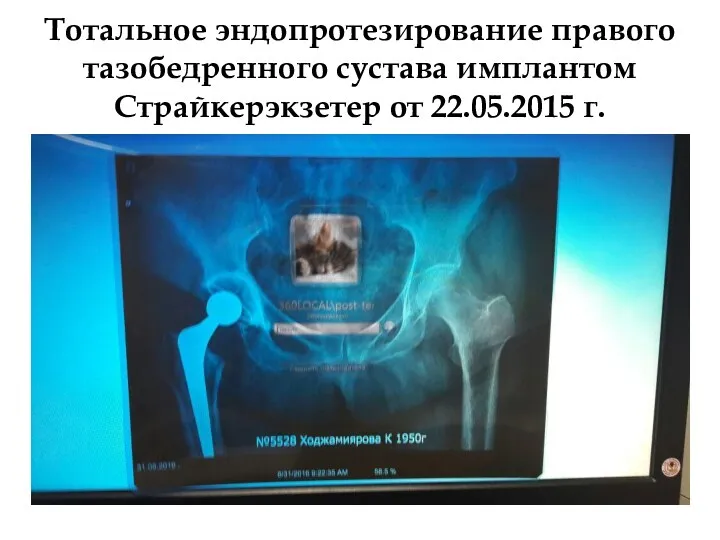 Тотальное эндопротезирование правого тазобедренного сустава имплантом Страйкерэкзетер от 22.05.2015 г.