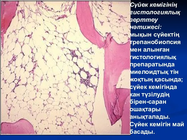 Сүйек кемігінің гистологиялық зерттеу нәтижесі: мықын сүйектің трепанобиопсиямен алынған гистологиялық препаратында миелоидтық тін