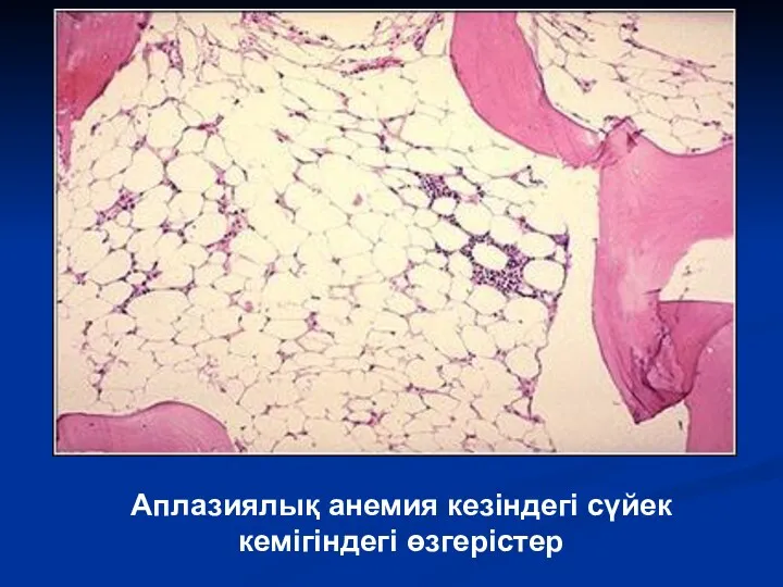 Аплазиялық анемия кезіндегі сүйек кемігіндегі өзгерістер