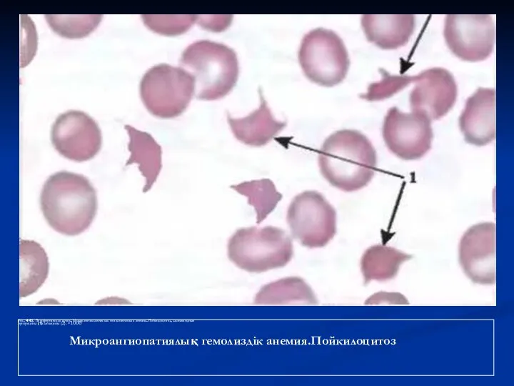 Рис. 443. Периферическая кровь. Микроангиопатическая гемолитическая анемия. Пойкилоцитоз, шлемовидные эритроциты (1) шизоциты (2).