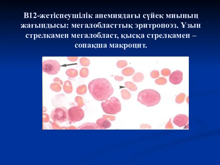 В12-жетіспеушілік анемиядағы сүйек миының жағындысы: мегалобласттық эритропоэз. Ұзын стрелкамен мегалобласт, қысқа стрелкамен – сопақша макроцит.