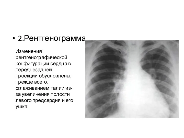 2.Рентгенограмма Изменения рентгенографической конфигурации серд­ца в переднезадней проекции обусловлены, прежде всего, сглаживанием талии