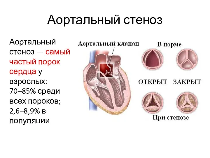 Аортальный стеноз Аортальный стеноз — самый частый порок сердца у взрослых: 70–85% среди