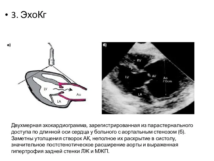 3. ЭхоКг Двухмерная эхокардиограмма, зарегистрированная из парастернального доступа по длинной оси сердца у
