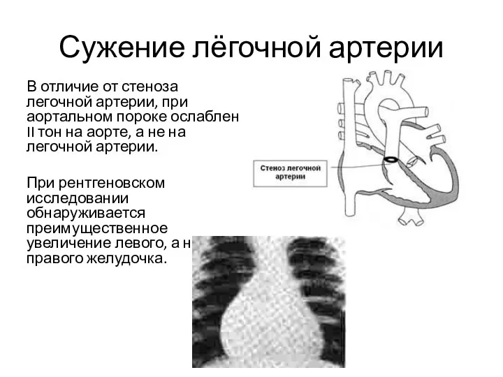Сужение лёгочной артерии В отличие от стеноза легочной артерии, при аортальном пороке ослаблен