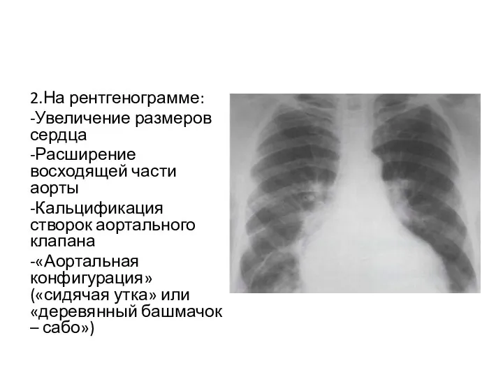 2.На рентгенограмме: -Увеличение размеров сердца -Расширение восходящей части аорты -Кальцификация створок аортального клапана