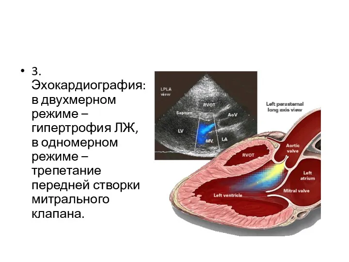 3. Эхокардиография: в двухмерном режиме – гипертрофия ЛЖ, в одномерном режиме – трепетание