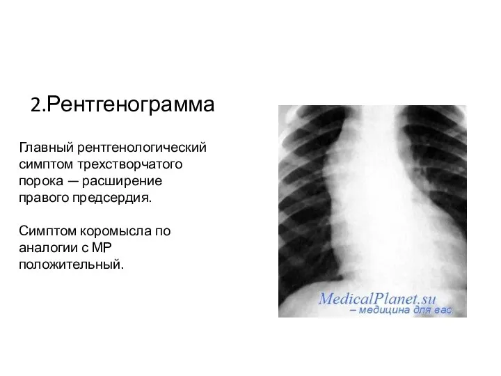 2.Рентгенограмма Главный рентгенологический симптом трехстворчатого порока — расширение правого предсердия. Симптом коромысла по
