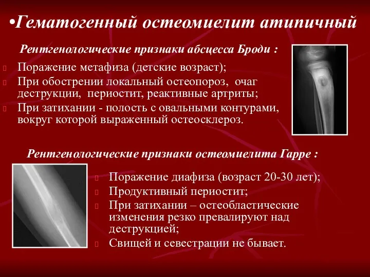 Поражение метафиза (детские возраст); При обострении локальный остеопороз, очаг деструкции,